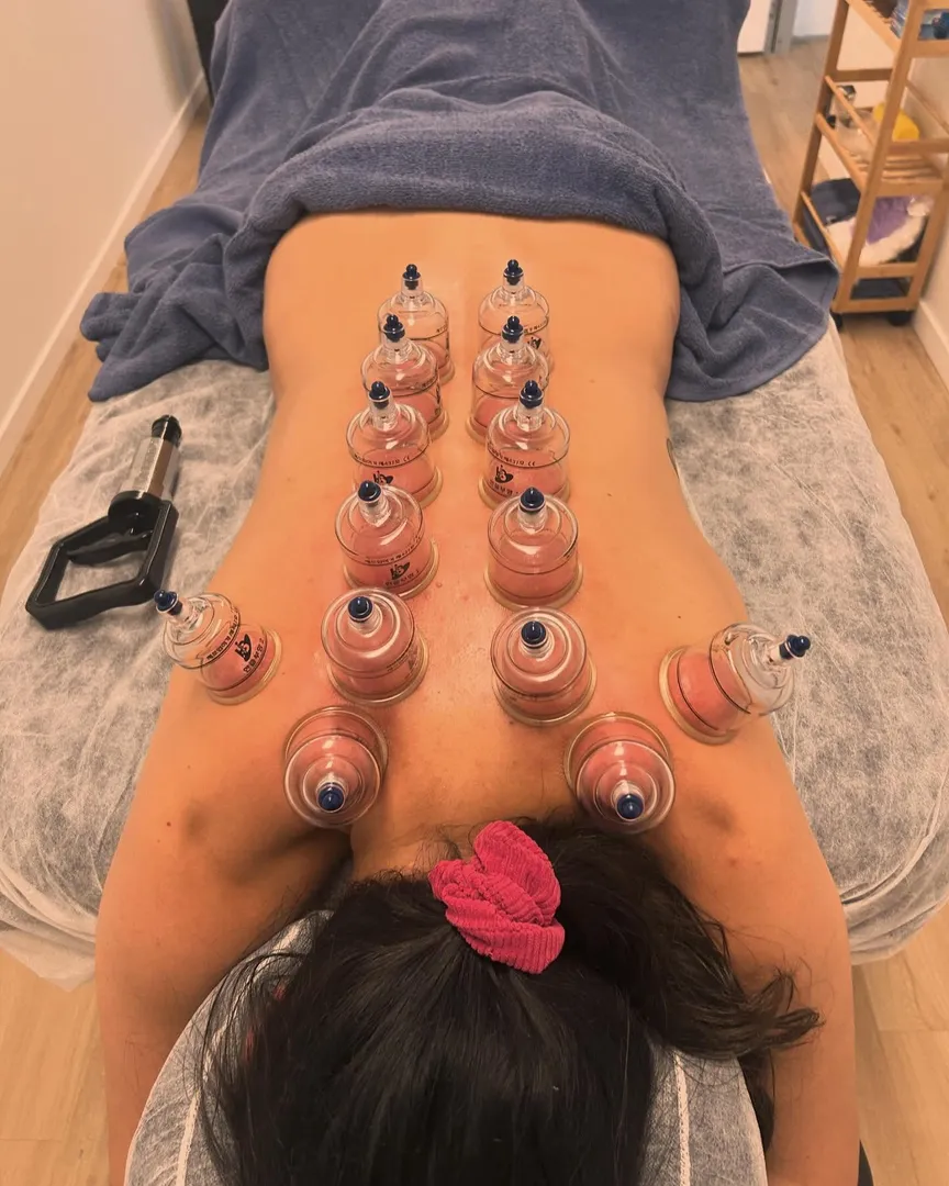 Person receiving cupping therapy on back.