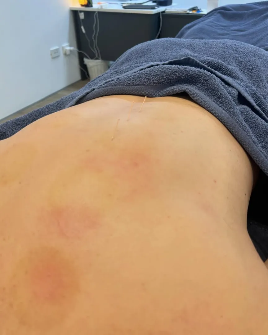 Back with acupuncture needles in clinic setting.